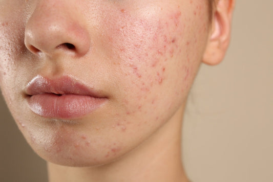 How to fix damaged skin barrier with Korean skincare products