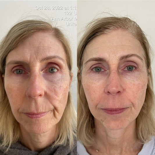 before and after 4 weeks krx korean anti aging face lift youthplex system - professional-grade skincare products