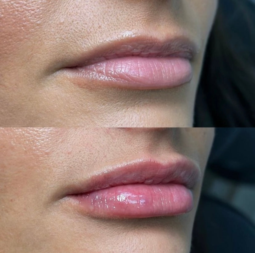 Before and after Korean Lip Filler Plumping Gloss from KrX Aesthetics | Mystic Beauty & Skincare