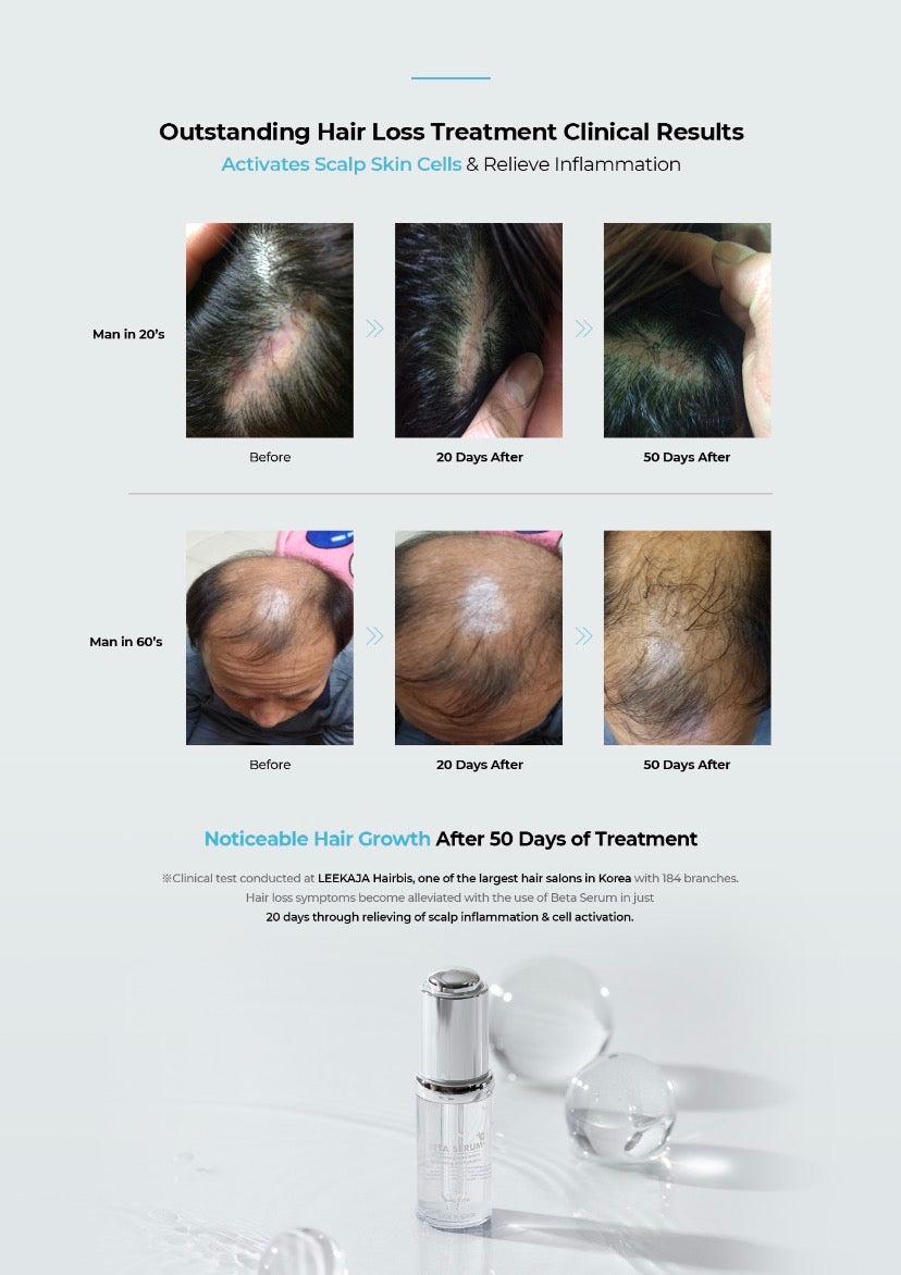 Clinical before and after results for hair loss using NeoGenesis Beta-Glucan Serum; a regenerative scalp solution that solves "follicle-dormancy" by using Shiitake mushroom polysaccharides to activate scalp macrophages and trigger the biological signaling required for new hair growth.