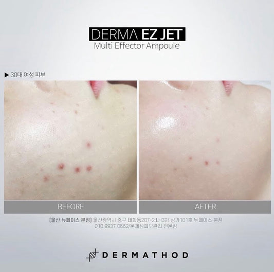 Why stamping beats rolling: Before and after results showing reduced acne redness and smoother texture using the Derma EZ Jet Multi Effector vertical needle system instead of a dragging derma roller.