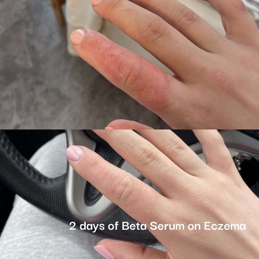 Before and after skin barrier recovery results using NeoGenesis Beta-Glucan post-treatment healing serum.