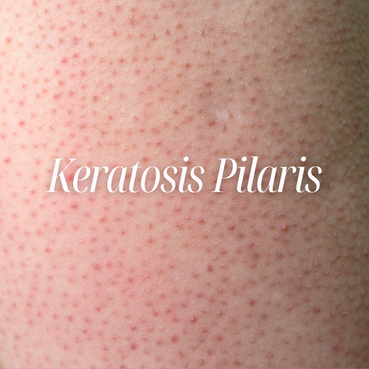 Korean skincare routine for keratosis pilaris