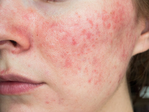 Best Korean Acne Skincare Routine: Ingredients & Top Products
