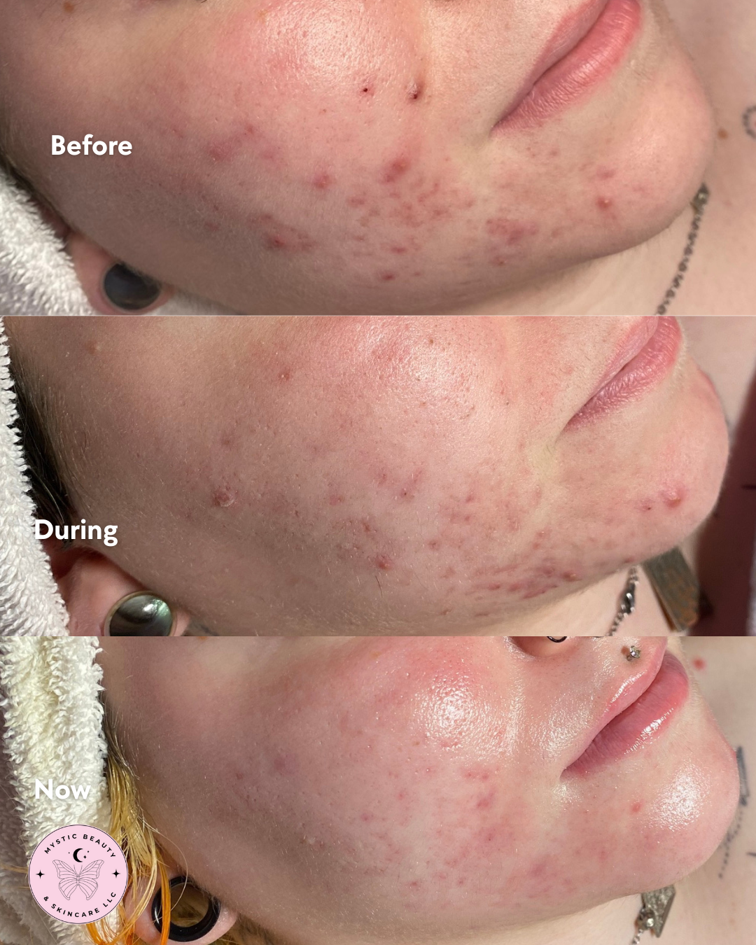 Korean acne treatment facial Boise and Garden City | Mystic Beauty & Skincare