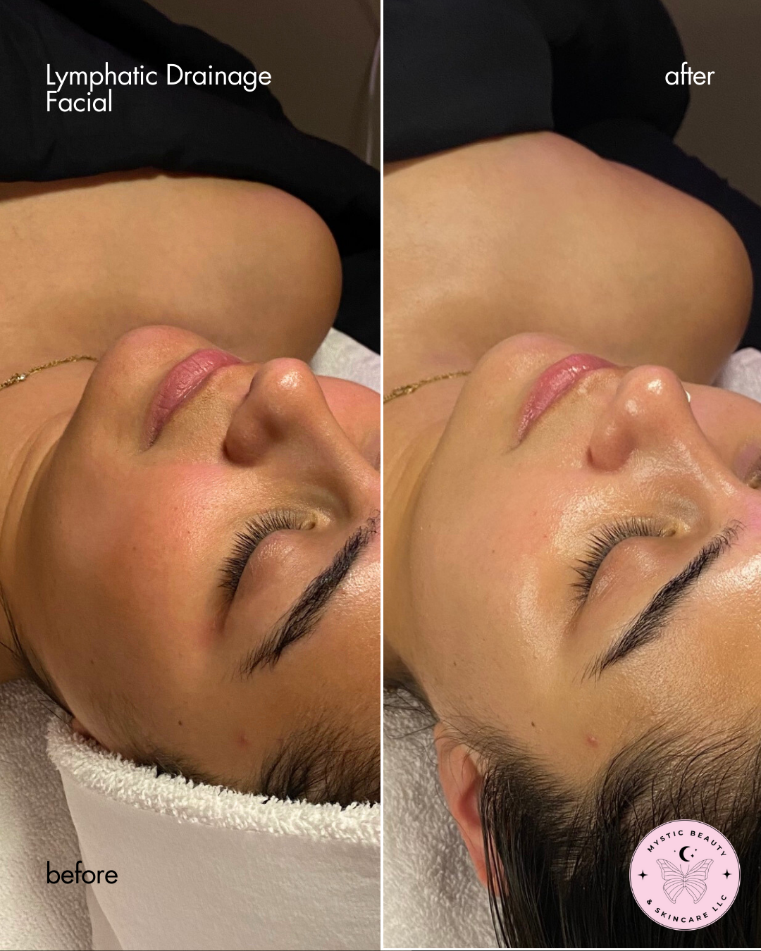Lymphatic drainage facial results Boise licensed esthetician | Mystic Beauty & Korean Skincare