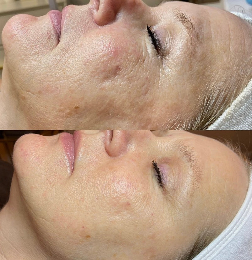 Before and after Procell Microchanneling - Boise Idaho Skincare