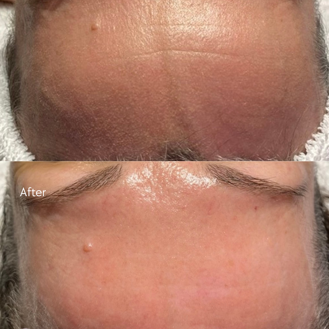 High-end Korean facial treatment with dermaplane exfoliation Boise Idaho | Mystic Beauty & Skincare