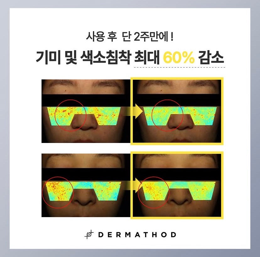 Visible melasma reduction before and after using Korean Dermathod Mela Effector; shows significant fading of cheek hyperpigmentation and improved skin tone.