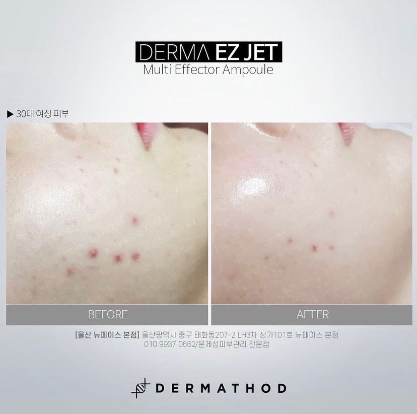 Before and after results of the Water Glow Kit showing increased skin density, plumpness, and a restored moisture barrier. Clinical Korean skincare.